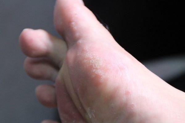 认识脚气，重视脚部健康，最新脚气广告来袭